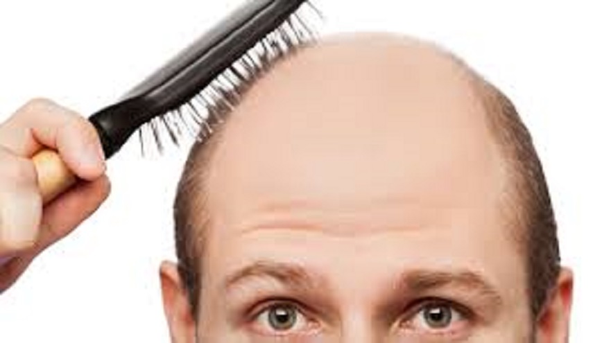 من هم الأكثر عرضة للصلع؟