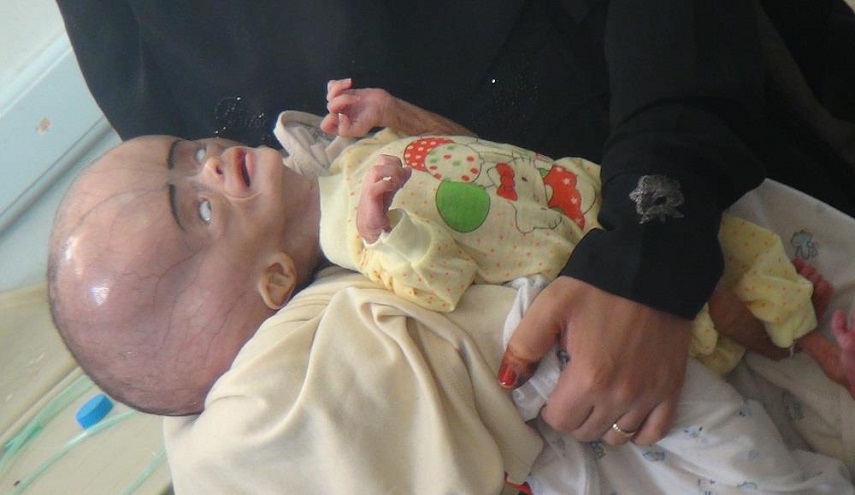 اليمن.. المواليد الجدد مشوهون بسبب الأسلحة الكيماوية