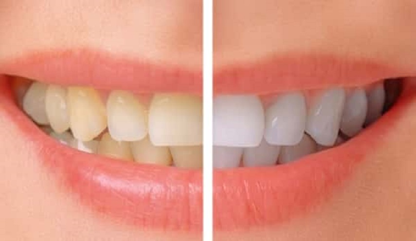 تخلص من اصفرار الأسنان حالًا.. بهذه الطريقة!