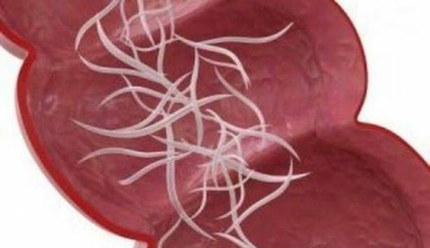 أمعاؤكم قد تكون مليئة بالطفيليات والديدان.. تخلصوا منها بهذه الوصفات