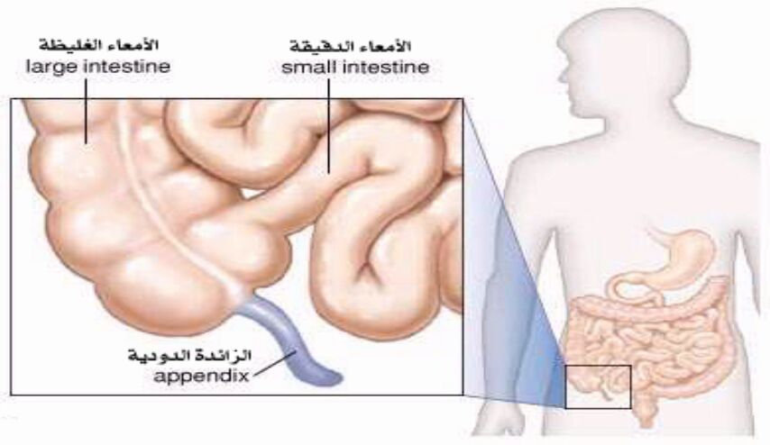 إلتهاب الزّائدة الدوديّة : الأعراض والعلامات وأهمّيّة التدخّل المبكّر