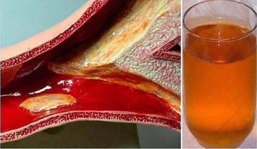  كدت أموت من نوبة قلبية بسبب انسداد شراييني ولكن هذا الشراب ساعدني على فتحها 