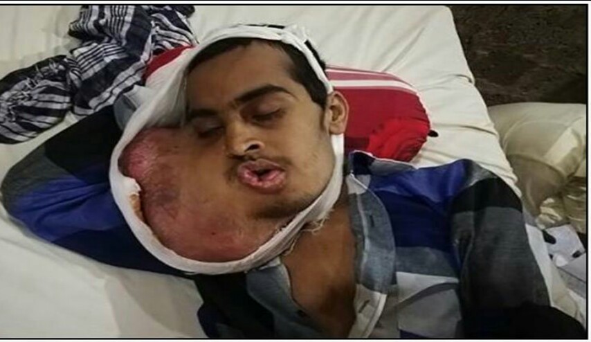 وفّر ثمن زيارة طبيب الاسنان.. والنتيجة سرطان قاتل في الفم!