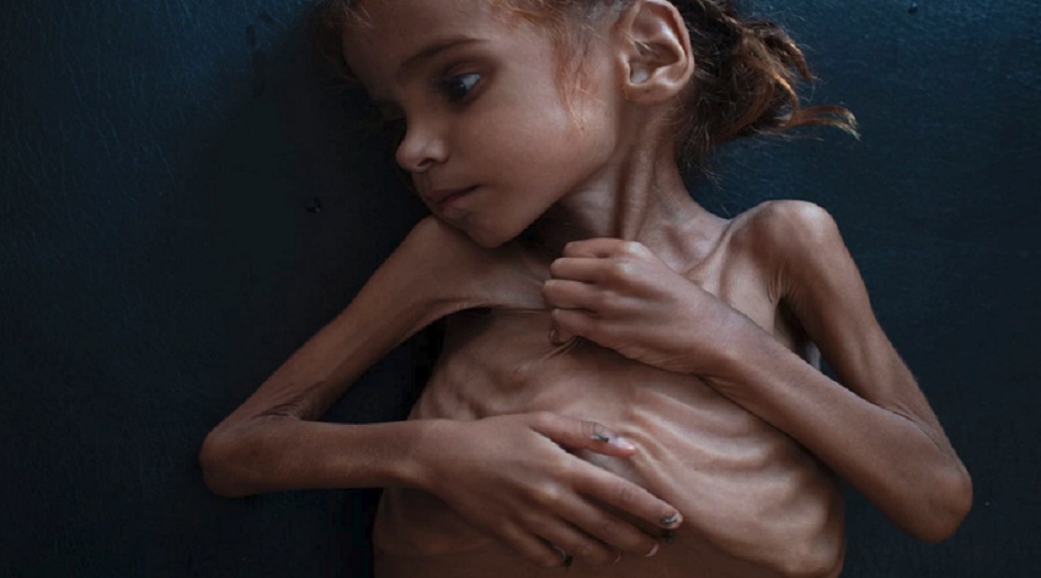 رحيل الطفلة التي فتحت عيون العالم على مأساة اليمن
