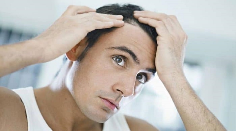تجنب تناول هذه الأطعمة لأنها تسبب الصلع
