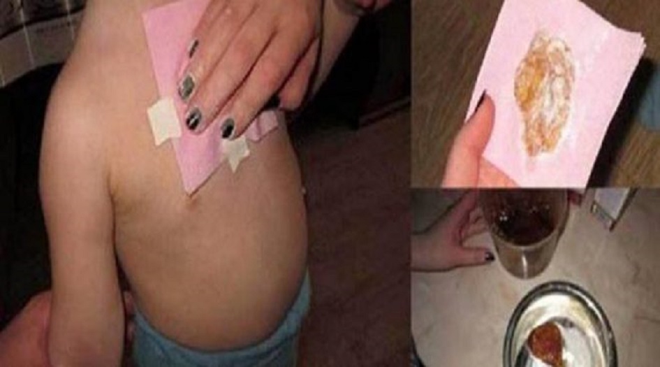 ضمادة الزنجبيل: تزيل البلغم من الرئتين في ليلة واحدة  وكما تعالج..؟!!