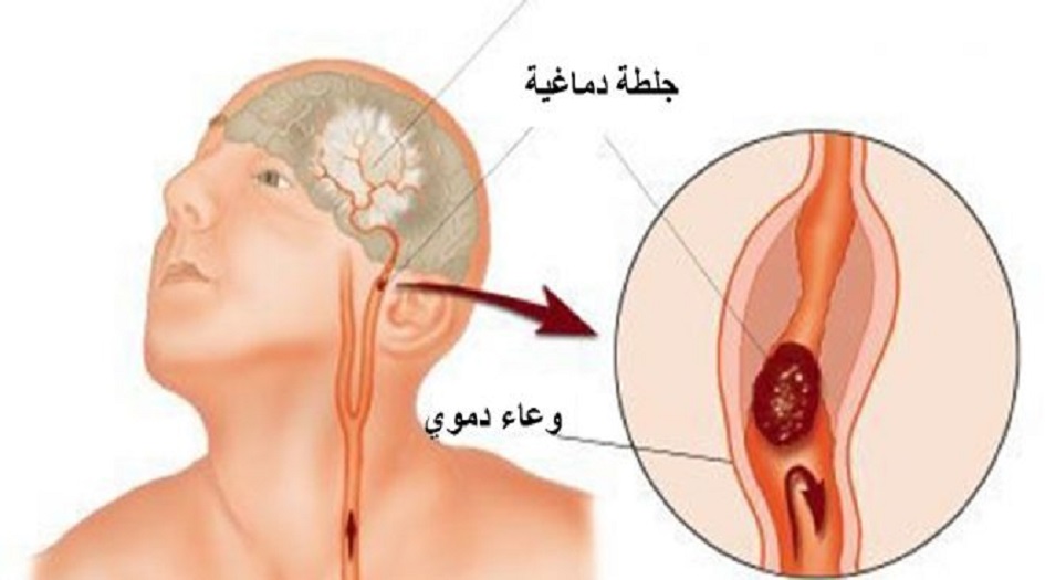 الجلطة الدماغية : تعرّفوا على هذه الحيل ال 4 كي تنقذوا حياتكم وحياة غيركم !