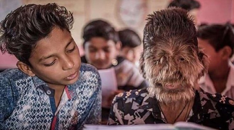 حالة مرضية غريبة.. ما قصة “الطفل الذئب” الكاملة؟.. صور