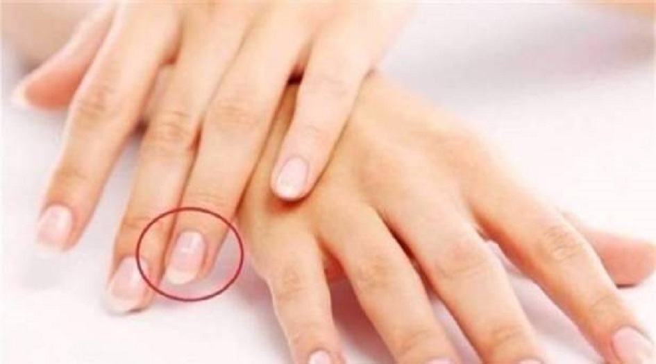 قد تدلّ على مرض بالقلب..لماذا تظهر بقع بيضاء على الأظافر؟