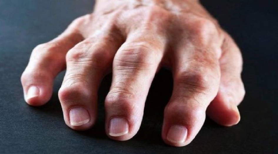 هل تتورم أصابعك؟ إليك 15 سبباً محتملاً
