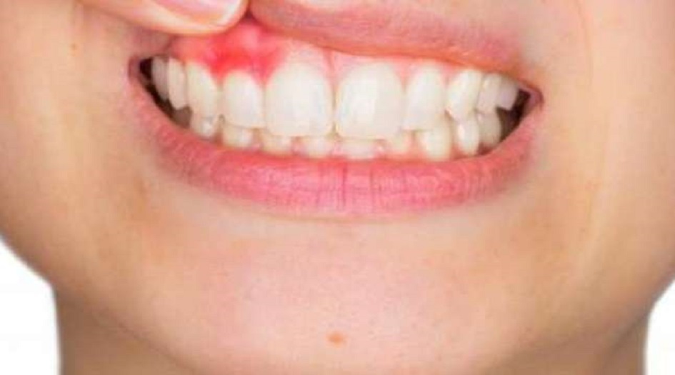 3 أعراض فموية تدل على حالة صحية خطيرة