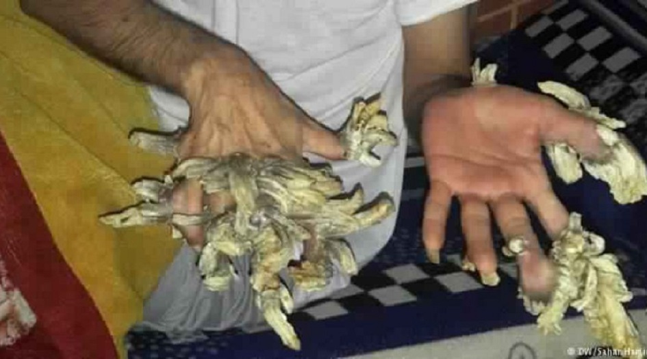 بعد خضوعه لـ25 عملية جراحية.. 