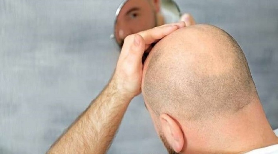 دراسة حديثة تكشف "أغرب سبب" للصلع