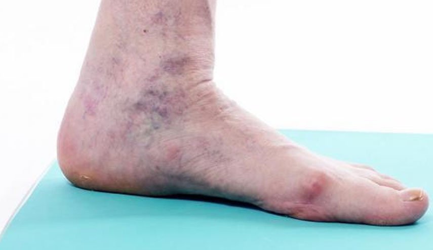 في 30 دقيقة.. علاج دوالي الساقين بدون أدوية