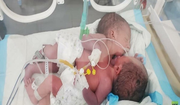 صنعاء تطالب الأمم المتحدة بإنقاذ حياة توأم سيامي في حالة حرجة