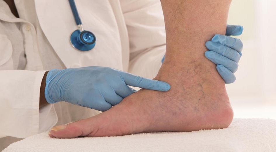 10 خطوات تساعدك في علاج دوالي الساقين
