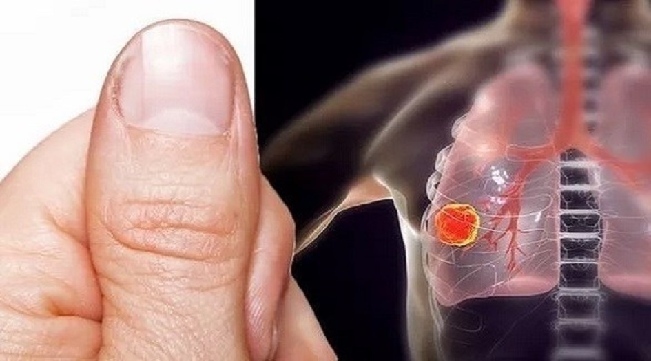 تغير شكل الأصابع ينذر بالإصابة بمرض قاتل