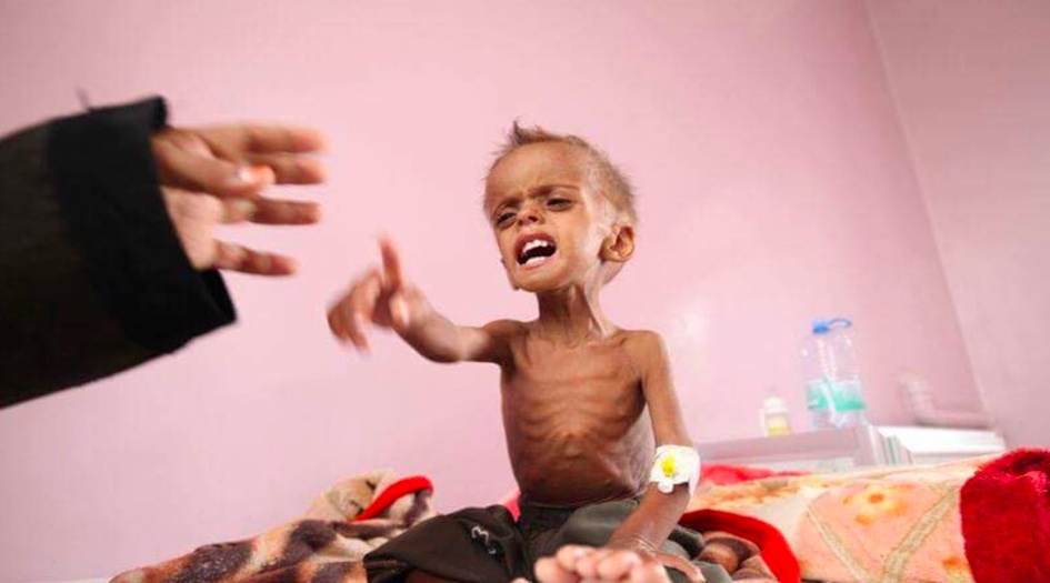 كل 5 دقائق طفل يموت يمني جراء استمرار العدوان والحصار