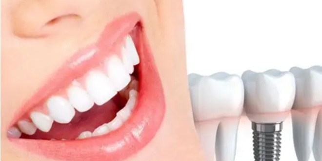 أسنان تبقى للأبد.. ثورة في مجال طب الأسنان
