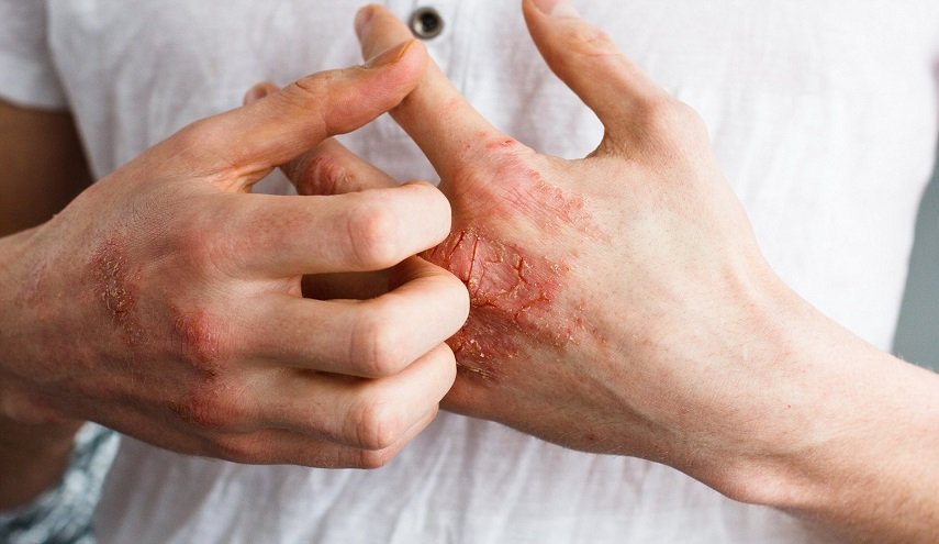 ماذا تعرف عن الـ"إكزيما" وكيف يمكن معالجتها؟