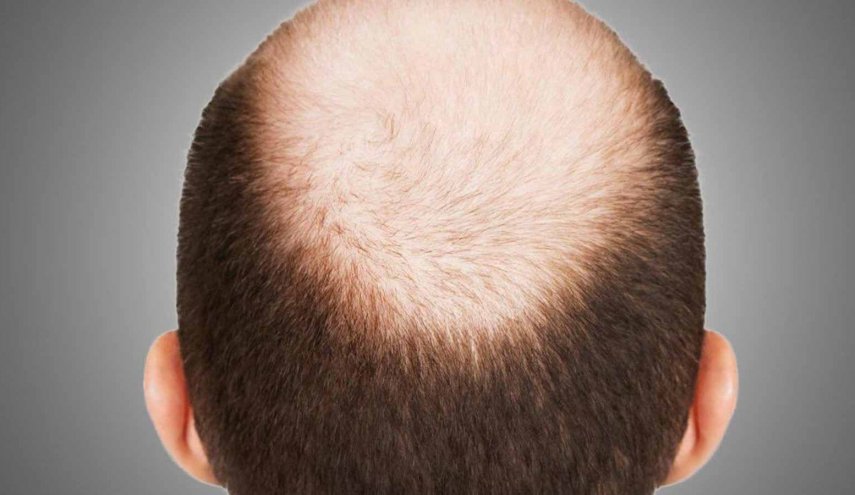 دواء واعد لإنتاج بصيلات شعر جديدة