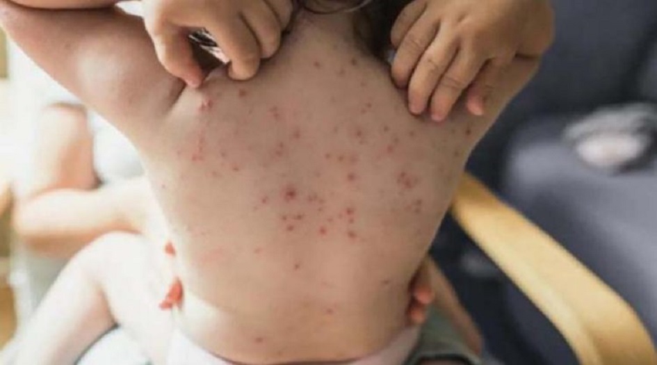 باحثة لبنانية تبدد مخاوف جدري القردة