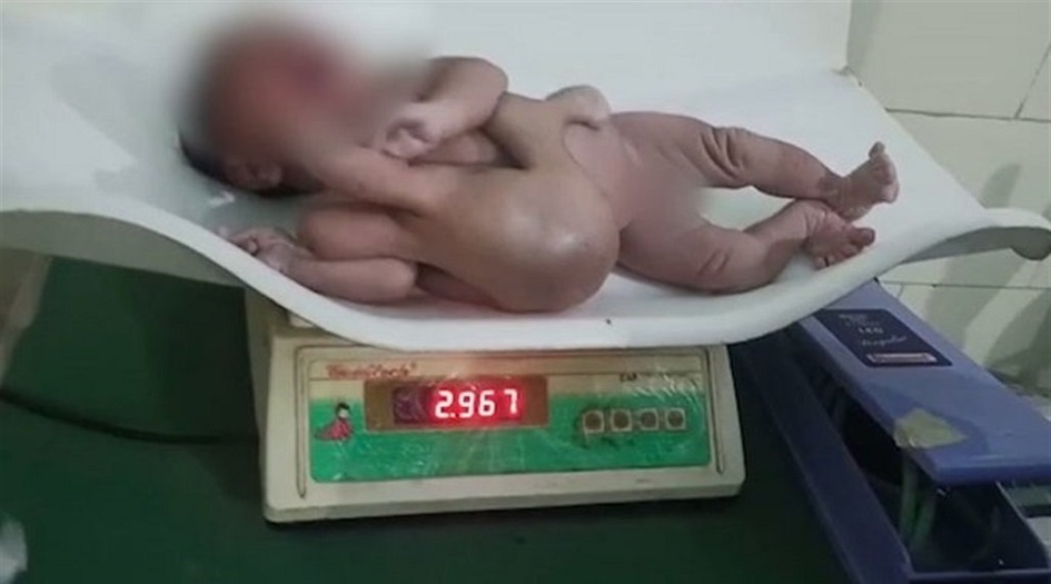 شاهد.. ولادة طفلة بـ 4 أذرع و4 أرجل في الهند