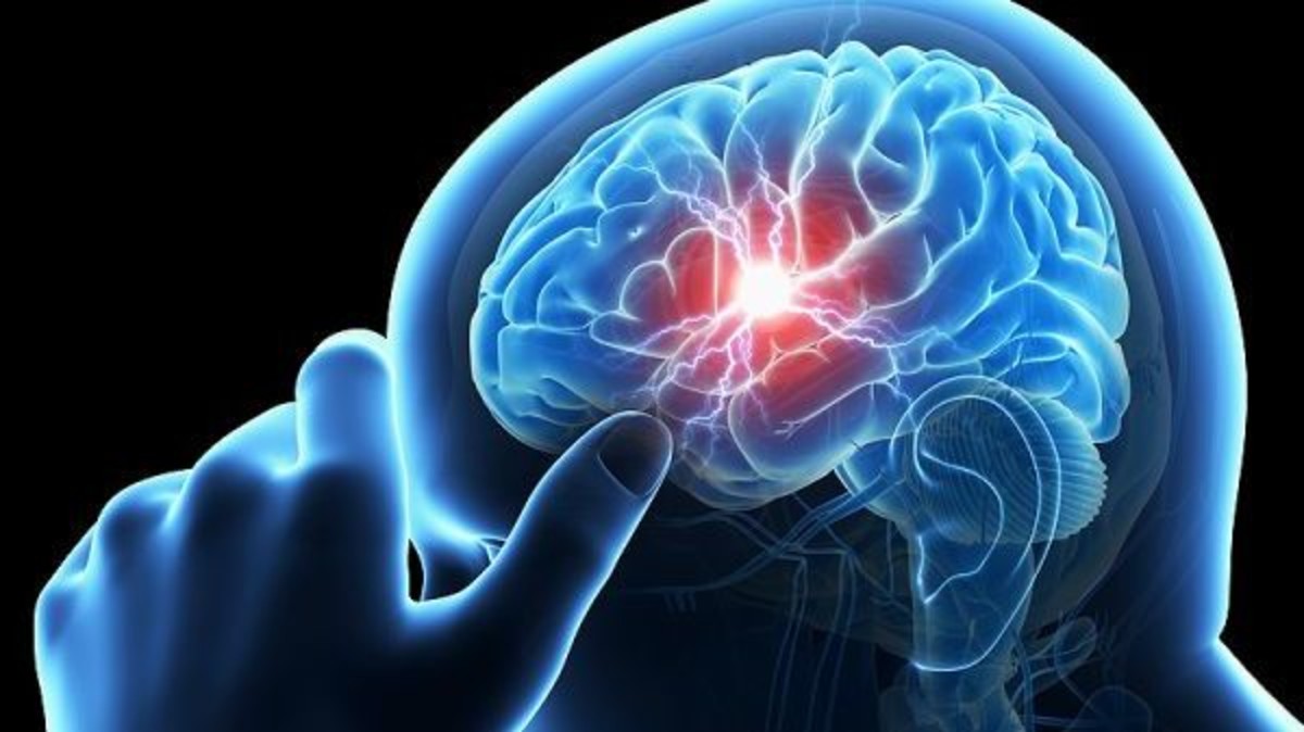 علامة تحذيرية للاصابة بالسكتة الدماغية