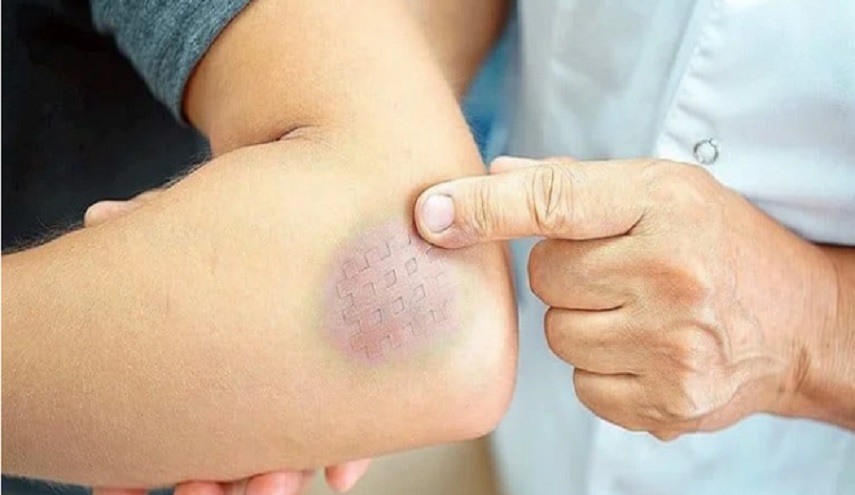 ما سبب ظهور بقع زرقاء على الجسم دون حدوث اصطدام أو إصابة؟