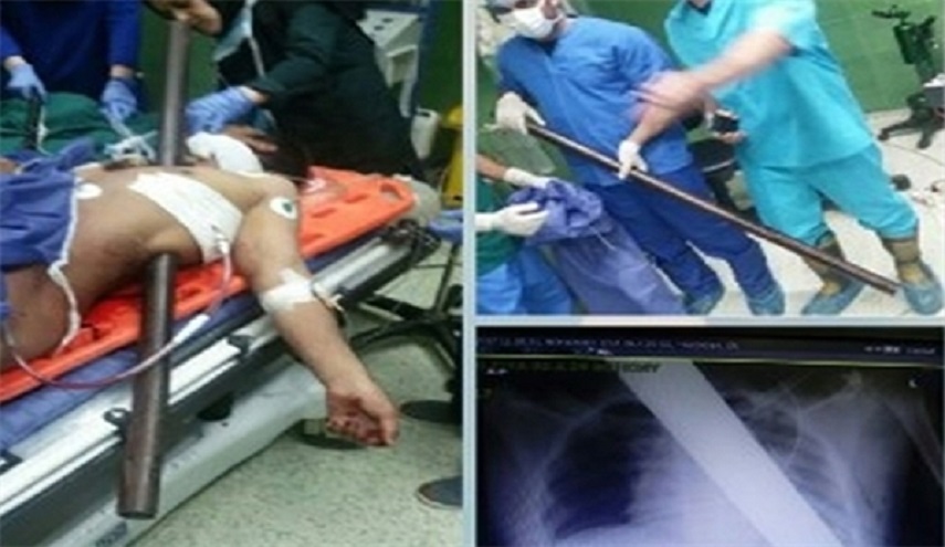 أطباء ايرانيون يخرجون قضيبا معدنيا طوله 2.5 متر انغرس في صدر عامل افغاني
