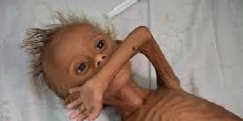 حرب اليمن تتسبب في ابتلاء أطفال كثيرين بسوء تغذية حاد