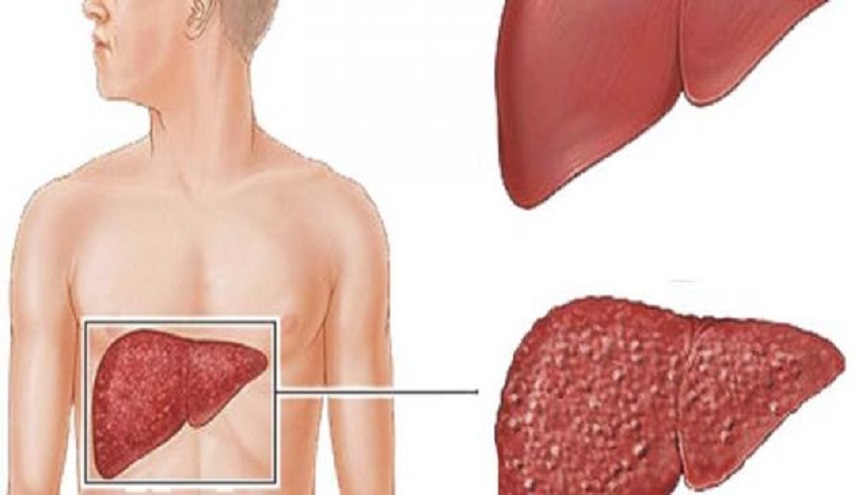علاج قياسي لمرضى التهاب الكبد "سي" خلال عامين