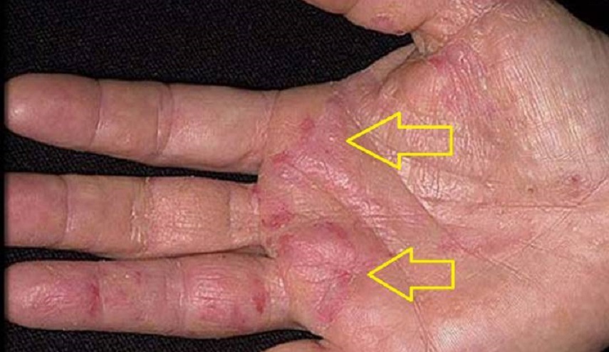  العوارض الأولى للسرطان تظهر على اليدين! كيف تكتشفونها ؟