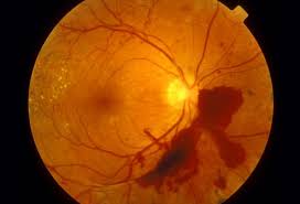 جلوگیری از کوری دیابت با لنز تماسی درخشان