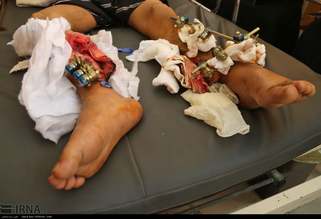 درمان مجروحان غزه با دستان خالی