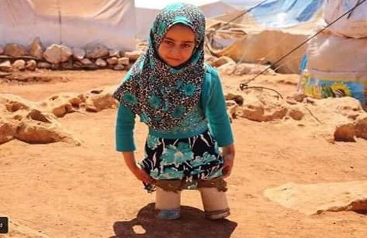 بالصور.. طفلة سورية نازحة مبتورة القدمين تستخدم “أواني فارغة” كأطراف صناعية 