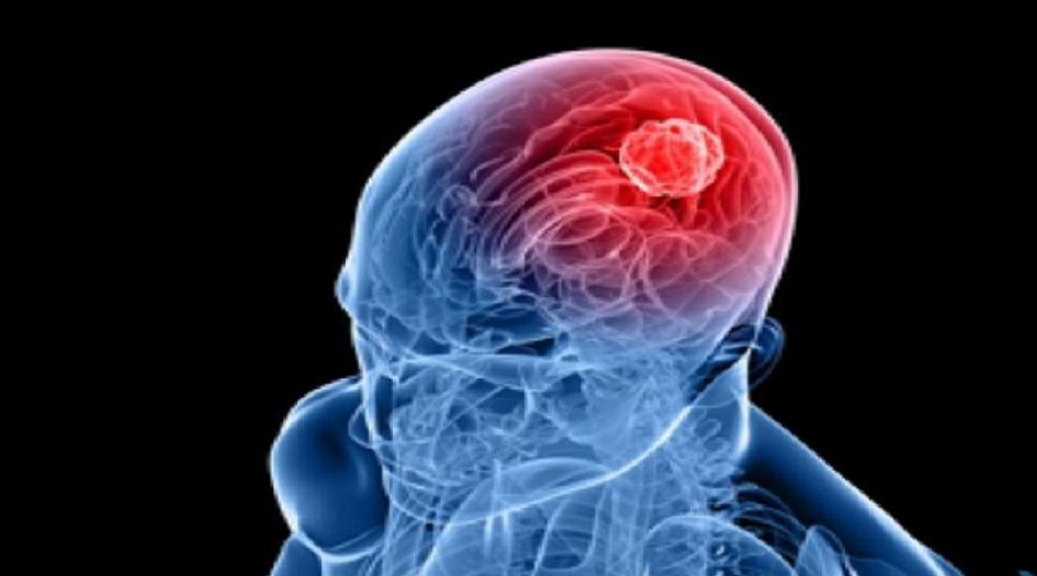 علاج جديد يحرق الخلايا السرطانية في الدماغ