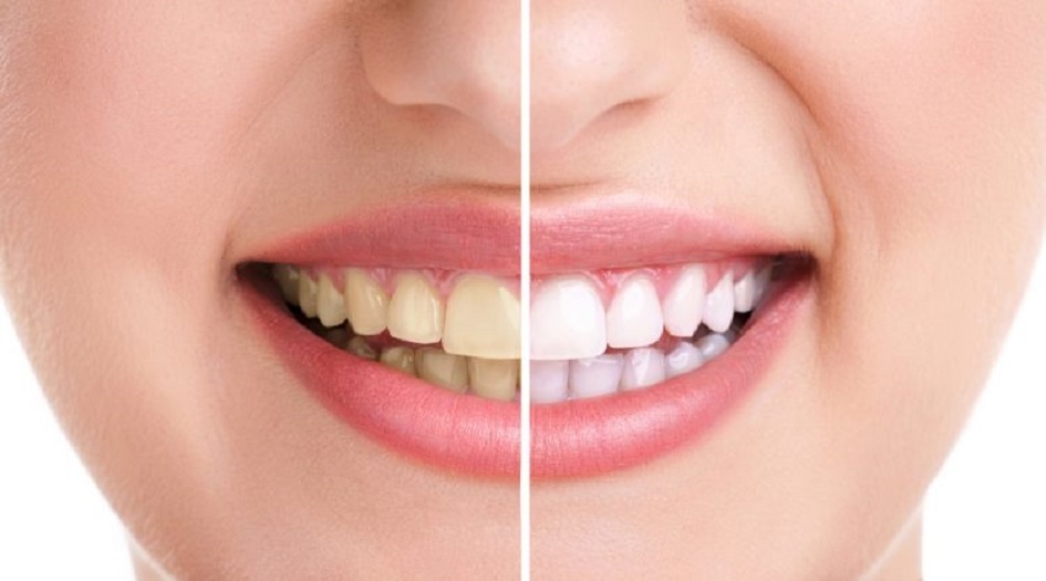 هذه المادة الكيميائية الجديدة تبيّض الأسنان دون الإضرار بطبقة المينا!