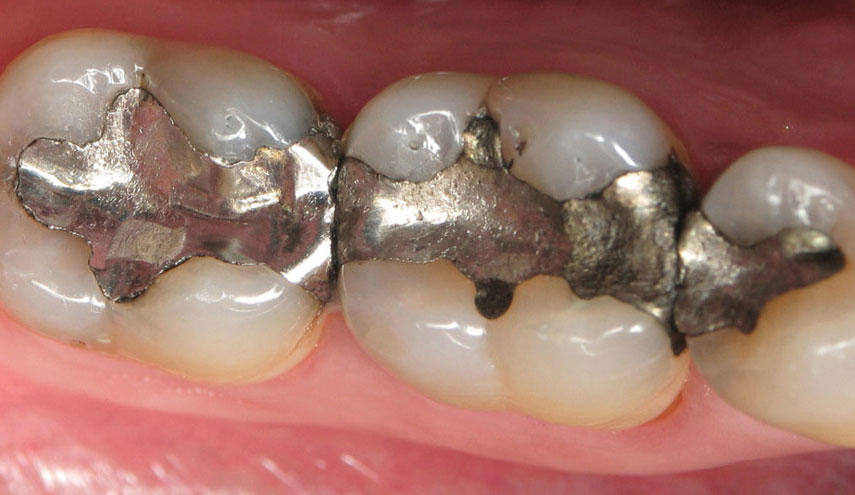 الحشو المعدني للأسنان ... خطر على الصحة..كيف؟