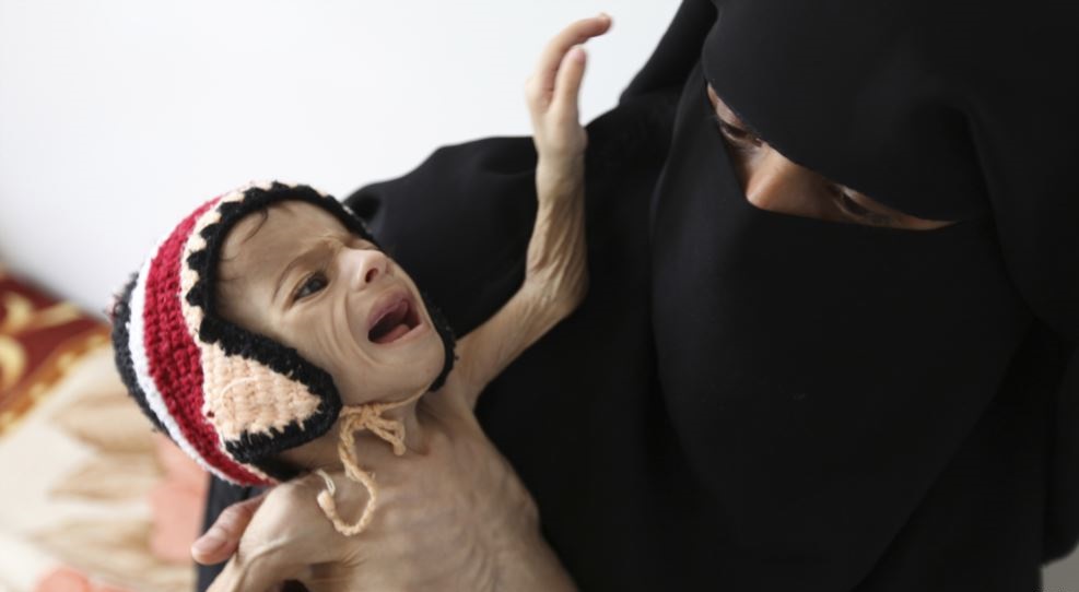 تشدید بحران سوء تغذیه کودکان در یمن