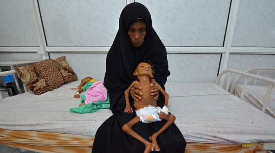 منظمة بريطانية: موت 85 ألف طفل يمني بسبب سوء التغذية الحاد