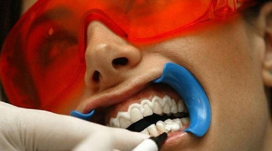 دراسة صادمة.. "تبييض الأسنان" أخطر مما تتصور