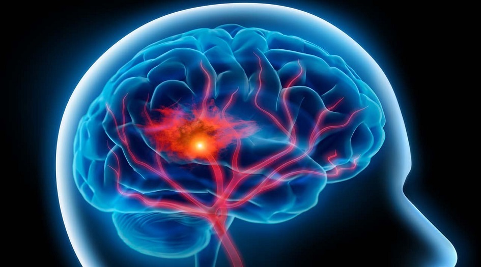 تحذير... 7 اعراض للسكتية الدماغية لا تتجاهلها 