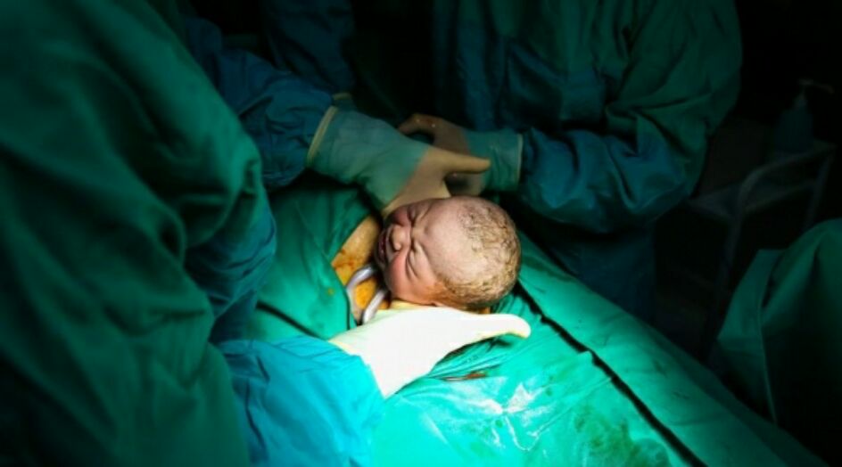 دراسة تكشف خطراً غير متوقع للأطفال المولودين قيصرياً