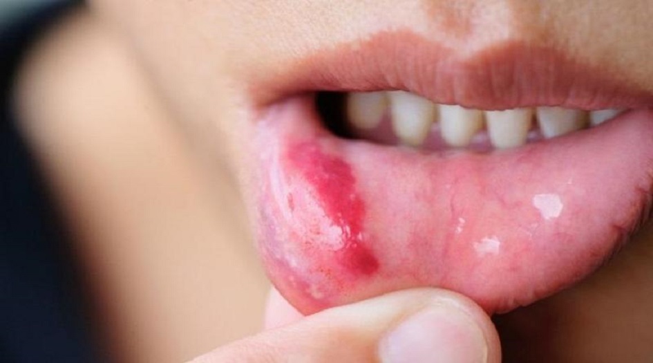 أعراض في الفم قد تكون علامات تحذيرية للإصابة بأزمة قلبية