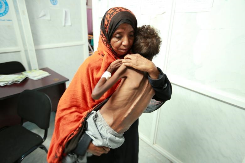 آمار بالای مرگ ومیر کودکان یمنی : هر 12 دقیقه، یک کودک زیر 5 سال جان خود را از دست می‌‌دهد