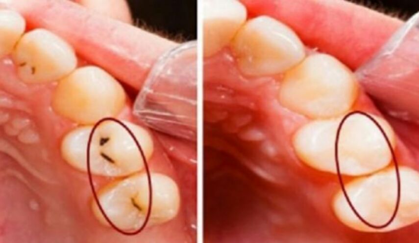 هل تعاني من تسوس أسنانك؟.. اليك هذا العلاج الطبيعي