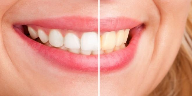 6 طرق لتبييض الأسنان دون الذهاب إلى طبيب الأسنان