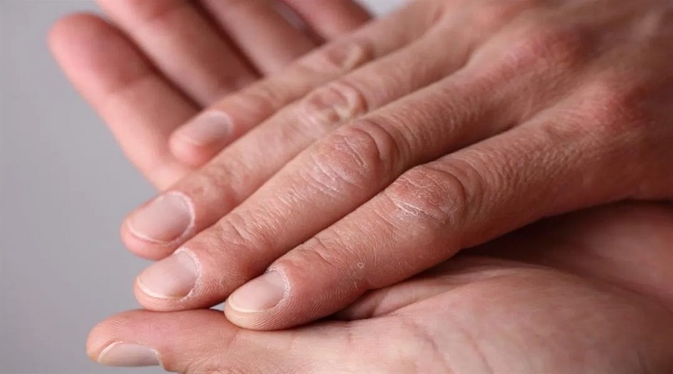 علامات على الأصابع تشير إلى الإصابة بسرطان الرئة
