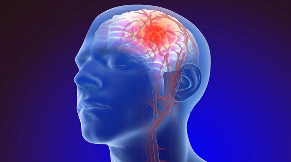 5 ممارسات صحية للحد من الإصابة بالسكتة الدماغية